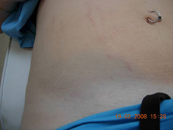 carboxy stretch mark therapy darien ct